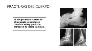 FRACTURAS DEL CUERPO
Se dan por traumatismos de
alta energía y cuando son
conminutas hay que hacer
artrodesis de tobillo tipo Blair.
 