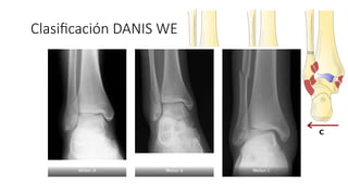 Clasificación DANIS WEBER
 