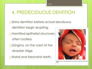 4. Developmental Disturbances.ppt of teeth x | PPTX