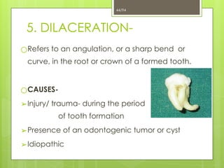 Sharp Linear Defect Tooth 4. Developmental Disturbances.ppt of teeth x | PPTX