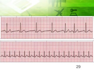 Wap Dan Atrial Takhikardia
29
 