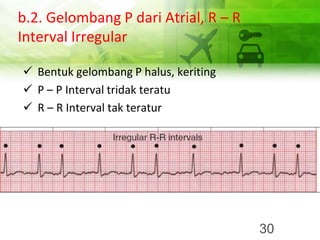 b.2. Gelombang P dari Atrial, R – R
Interval Irregular
✓ Bentuk gelombang P halus, keriting
✓ P – P Interval tridak teratu
✓ R – R Interval tak teratur
30
 