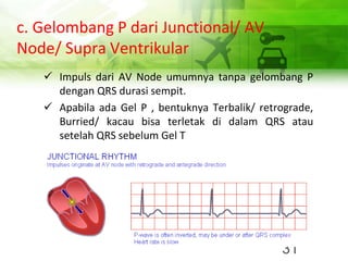 c. Gelombang P dari Junctional/ AV
Node/ Supra Ventrikular
✓ Impuls dari AV Node umumnya tanpa gelombang P
dengan QRS durasi sempit.
✓ Apabila ada Gel P , bentuknya Terbalik/ retrograde,
Burried/ kacau bisa terletak di dalam QRS atau
setelah QRS sebelum Gel T
31
 
