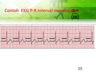 Contoh EKG P-R Interval memanjang
35
 