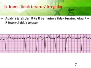 b. Irama tidak teratur/ Irregular
• Apabila jarak dari R ke R berikutnya tidak teratur. Atau R –
R Interval tidak teratur
7
 
