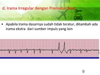 d. Irama Irregular dengan Prematur Beat
• Apabila Irama dasarnya sudah tidak teratur, ditambah ada
irama ekstra dari sumber impuls yang lain
9
 
