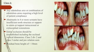 Class Iv Rpd 4. Diagnosis and treatment planning in RPD.pptx