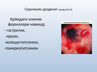Сурункали дуоденит (Шифр R29.8)
Қуйидаги клиник
формалари мавжуд:
- гастритик,
-ярали,
-холециститсимон,
-панкреатитсимон
 