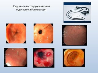 Сурункали гастродуоденитнинг
эндоскопик кўринишлари
 