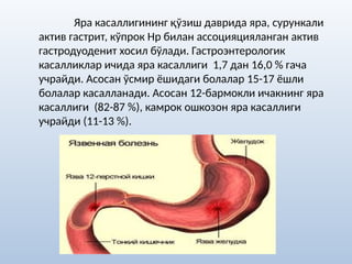 Яра касаллигининг қўзиш даврида яра, сурункали
актив гастрит, кўпрок Нр билан ассоцияцияланган актив
гастродуоденит хосил бўлади. Гастроэнтерологик
касалликлар ичида яра касаллиги 1,7 дан 16,0 % гача
учрайди. Асосан ўсмир ёшидаги болалар 15-17 ёшли
болалар касалланади. Асосан 12-бармокли ичакнинг яра
касаллиги (82-87 %), камрок ошкозон яра касаллиги
учрайди (11-13 %).
 
