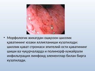 • Морфологик жихатдан ошқозон шиллик
қаватининг юзаки яллиғланиши кузатилади:
шиллик қават стромаси эпителий ости қаватининг
шиши ва чуқурчаларда и полиморф-хужайрали
инфильтрация лимфоид элементлар билан бирга
кузатилади.
 