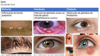 Hordeolo Oftalmologia, Principais Patologia da Palpebra.pptx