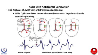 Pediatric-Arrhythmias hashemite university df | PDF