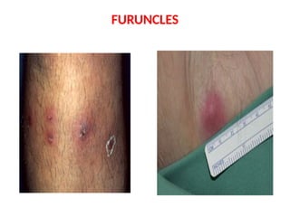 Comprehensive Overview of Superficial Bacterial Skin Infections and ...