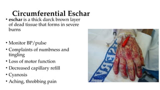 classification and management of Burns.. | PPTX