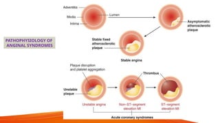 Comprehensive Drug Therapy for Angina Pectoris and Myocardial ...