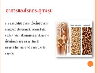 อาการของโรคกระดูกพรุน
ระยะแรกมักไม่มีอาการ เมื่อเริมมีอาการ
                             ่
แสดงว่าเป็ นโรคมากแล้ว อาการสาคัญ
ของโรค ได้แก่ ปวดตามกระดูกส่วนกลาง
  ่ั ้
ทีรบนาหนัก เช่น กระดูกสันหลัง
กระดูกสะโพก และอาจมีอาการปวดข้อ
ร่วมด้วย
 