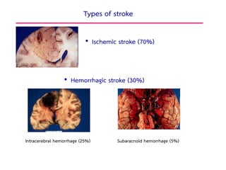• Ischemic stroke (70%)
Types of stroke
Intracerebral hemorrhage (25%)
• Hemorrhagic stroke (30%)
Subaracnoid hemorrhage (5%)
26
 