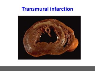 Transmural infarction
 