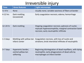 Irreversible injury
Time Gross features Light microscopy
½–4 hr None Usually none; variable waviness of fibers at border
4-12 hrs Dark mottling
(occasional)
Early coagulation necrosis; edema; hemorrhage
12–24 hr Dark mottling Ongoing coagulation necrosis; pyknosis of nuclei;
myocyte hypereosinophilia; marginal contraction band
necrosis; early neutrophilic infiltrate
1–3 days Mottling with yellow-tan
infarct center
Coagulation necrosis, with loss of nuclei and
striations; brisk interstitial infiltrate of neutrophils
3–7 days Hyperemic border;
central yellow-tan
softening
Beginning disintegration of dead myofibers, with dying
neutrophils; early phagocytosis of dead cells by
macrophages at infarct border
 