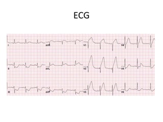 ECG
 