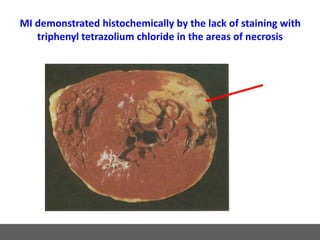 MI demonstrated histochemically by the lack of staining with
triphenyl tetrazolium chloride in the areas of necrosis
 
