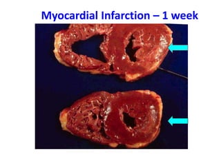 Myocardial Infarction – 1 week
 