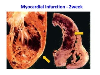 Myocardial Infarction - 2week
 