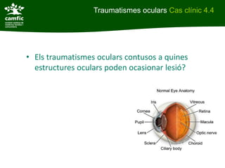 Traumatismes oculars Cas clínic 4.4




• Els traumatismes oculars contusos a quines
  estructures oculars poden ocasionar lesió?
 