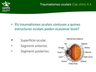 Traumatismes oculars Cas clínic 4.4




• Els traumatismes oculars contusos a quines
  estructures oculars poden ocasionar lesió?


•    Superficie ocular.
•    Segment anterior.
•    Segment posterior.
 