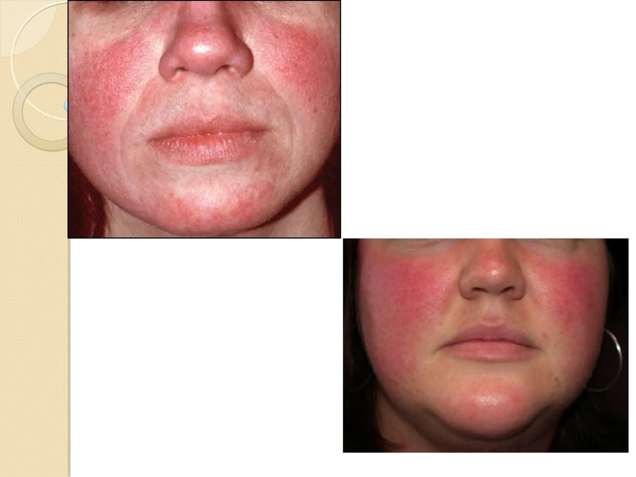 Pretty Roses Rash Mild Rosacea is a Latin word meaning (Like-Roses), is an Acne-like rash ...