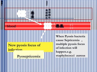 blood
局
部
病
灶
局
部
病
灶
毒素toxin
毒
素
毒
素
toxin
New pyosis focus of
infection
Pyosepticemia
When Pyosis bacteria
cause Septicemia ，
multiple pyosis focus
of infection will
happen.e.g.
staphylococci aureus
 