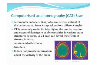 Computerised axial tomography (CAT) Scan 
  A computer enhanced X‐ray of a slice (cross‐section) of 
    the brain created from X‐rays taken from diﬀerent angles. 
  CT is extremely useful for identifying the precise location 
    and extent of damage to or abnormalities in various brain 
    structures or areas.  A CT scan can reveal the eﬀects of 
    strokes, tumors, 
   injuries and other brain  
   disorders 
  It does not provide information  
    about the activity of the brain 
 