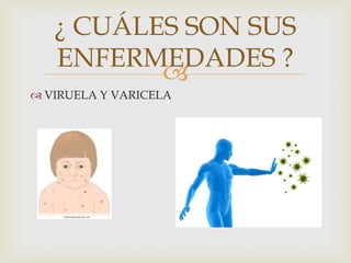 
¿ CUÁLES SON SUS
ENFERMEDADES ?
 VIRUELA Y VARICELA
 