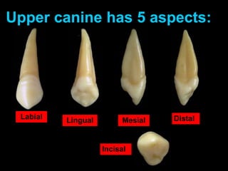 Labial Lingual Mesial Distal
Incisal
Upper canine has 5 aspects:
 