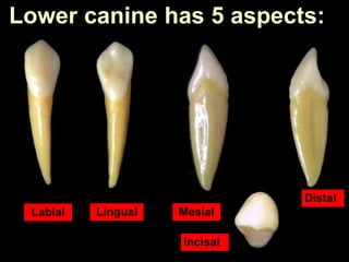 Labial Lingual Mesial
Distal
Incisal
Lower canine has 5 aspects:
 
