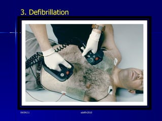 <ul><li>3. Defibrillation </li></ul>04/04/11 sdelfin2010 