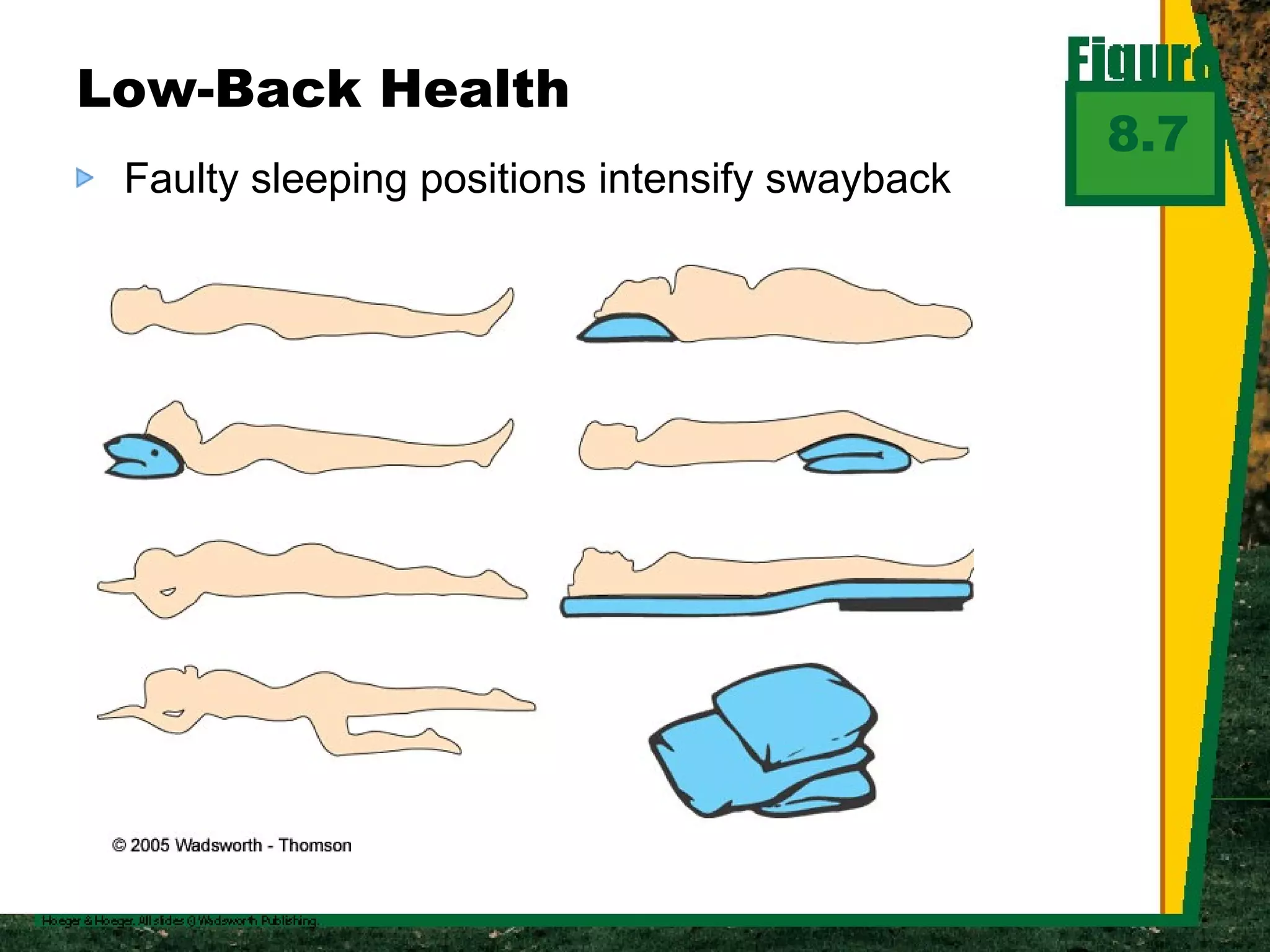 Faulty sleeping positions intensify swayback Low-Back Health 8.7 