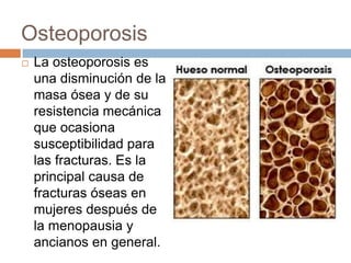 Enfermedades en el Sistema Óseo
