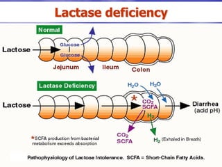 Lactase deficiency
 
