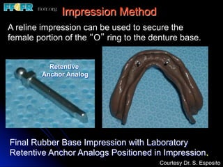 Edentulous Mandible - Overlay Oentures | PDF