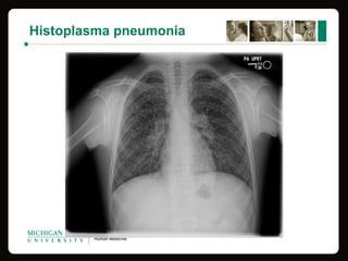 Histoplasma pneumonia
 