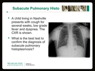 Subacute Pulmonary Histo
 A child living in Nashville
presents with cough for
several weeks, low grade
fever and dyspnea. The
CXR is shown.
 What is the best test to
confirm the diagnosis of
subacute pulmonary
histoplasmosis?
 