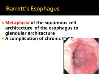 ◾ Metaplasia of the squamous cell
architecture of the esophagus to
glandular architecture
◾ A complication of chronic GERD
 