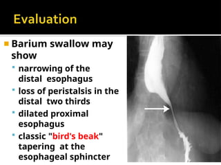 ◾ Barium swallow may
show
 narrowing of the
distal esophagus
 loss of peristalsis in the
distal two thirds
 dilated proximal
esophagus
 classic "bird's beak"
tapering at the
esophageal sphincter
 