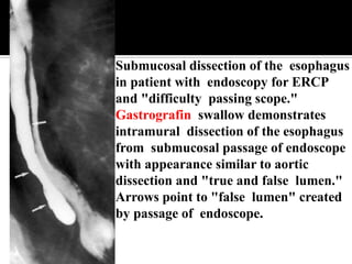 Submucosal dissection of the esophagus
in patient with endoscopy for ERCP
and "difficulty passing scope."
Gastrografin swallow demonstrates
intramural dissection of the esophagus
from submucosal passage of endoscope
with appearance similar to aortic
dissection and "true and false lumen."
Arrows point to "false lumen" created
by passage of endoscope.
 