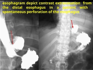 esophagram depict contrast extravasation from
the distal esophagus in a patient with
spontaneous perforation of the esophagus
 