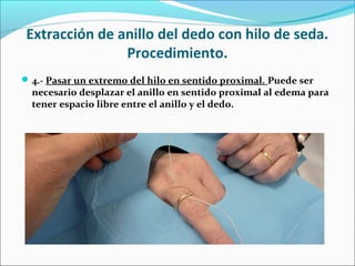 Extracción de anillo del dedo con hilo de seda.
Procedimiento.
4.- Pasar un extremo del hilo en sentido proximal. Puede ser
necesario desplazar el anillo en sentido proximal al edema para
tener espacio libre entre el anillo y el dedo.
 