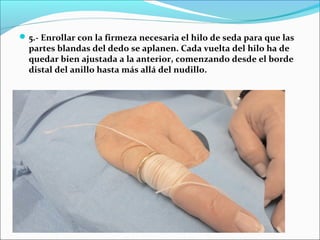 5.- Enrollar con la firmeza necesaria el hilo de seda para que las
partes blandas del dedo se aplanen. Cada vuelta del hilo ha de
quedar bien ajustada a la anterior, comenzando desde el borde
distal del anillo hasta más allá del nudillo.
 