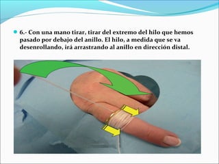6.- Con una mano tirar, tirar del extremo del hilo que hemos
pasado por debajo del anillo. El hilo, a medida que se va
desenrollando, irá arrastrando al anillo en dirección distal.
 